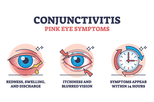 Conjunctivitis pink eye symptoms