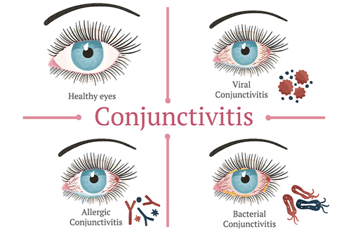 Pink eye symptoms quadrant